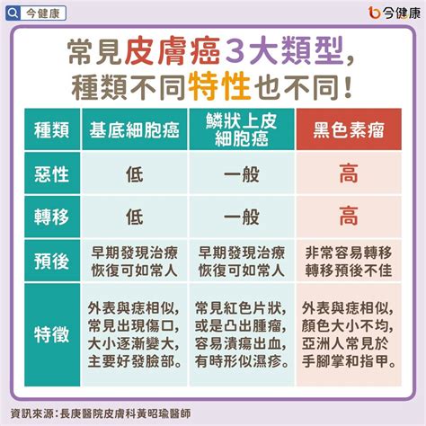 身體長誌|皮膚長痣是皮膚癌嗎？常見症狀，簡單3招自我檢測｜元氣